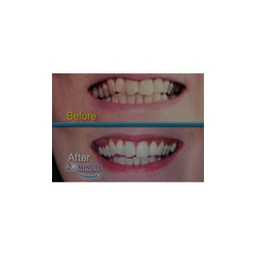 جرم گیر ، لمینت و بلیچینگ دندان وایت اسمایل (White smile) مدل sfz-20