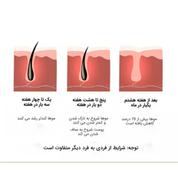 لیزر موهای زائد مدل IPL