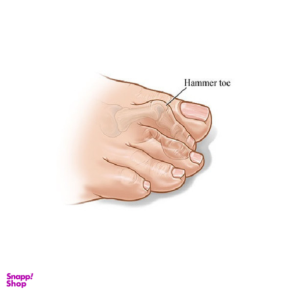 فاصله دهنده انگشت پا طب و صنعت مدل همرتو کد 10800