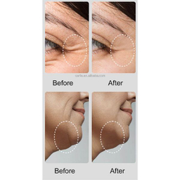 دستگاه جوانسازی و لیفت پوست مدل DR-06