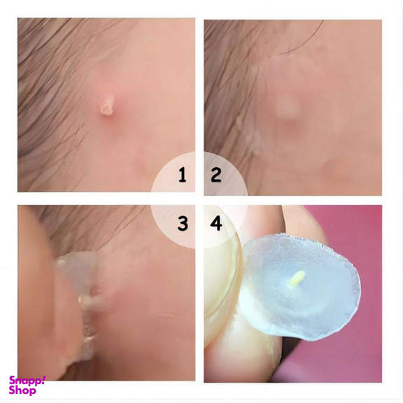 پچ ضد جوش سادور مدل سالیسیلیک اسید بسته 36 عددی