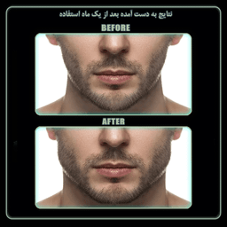 زاویه ساز فک رادیس فیت مدل Full Weight بسته 6 عددی