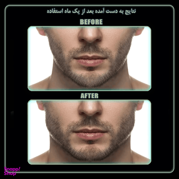 زاویه ساز فک رادیس فیت مدل Full Weight بسته 6 عددی