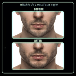 دستگاه زاویه ساز فک رادیس فیت مدل Light Weight بسته 2 عددی