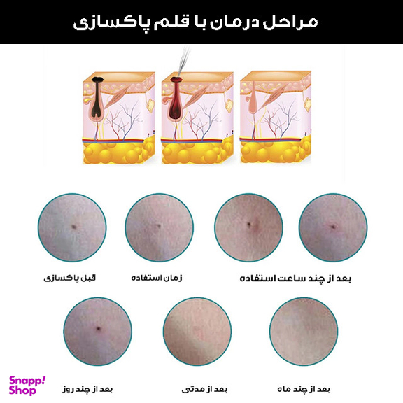 قلم پاک سازی پوست کد ZM-604