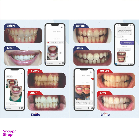 کیت بلیچینگ سفید کننده دندان خانگی دنتیلایت مدل Smile مجموعه 5 عددی